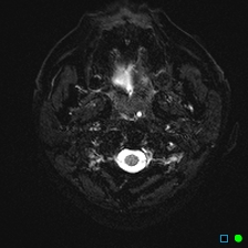 File:Brain death on MRI and CT angiography (Radiopaedia 42560-45689 Axial ADC 1).jpg