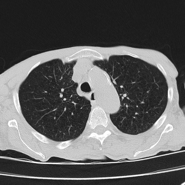 Brain metastases from lung cancer (Radiopaedia 27849-28093 Axial lung window 18).jpg