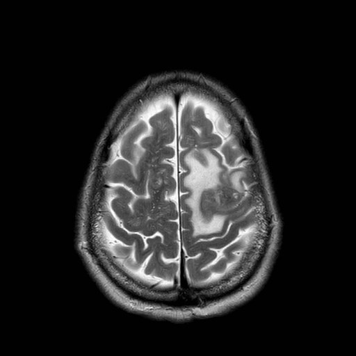 File:Brain metastases from lung cancer (Radiopaedia 83839-99028 Axial T2 30).jpg