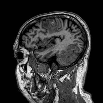 Brain metastases from lung cancer (Radiopaedia 83839-99028 Sagittal T1 100).jpg