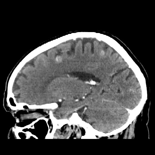 Brain metastasis (Radiopaedia 42617-45760 D 19).jpg