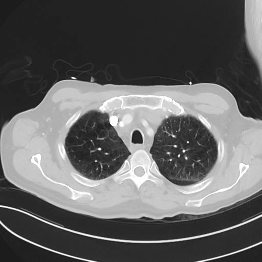 File:Brain metastasis (lung cancer) (Radiopaedia 48289-53180 Axial lung window 14).png
