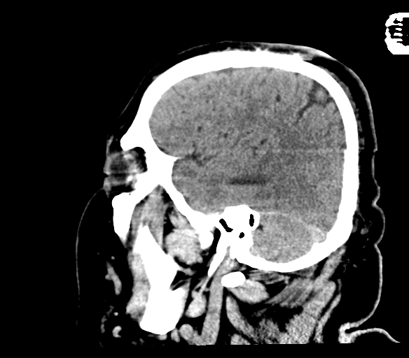 Brainstem hemorrhage (Radiopaedia 81294-94976 C 45).jpg