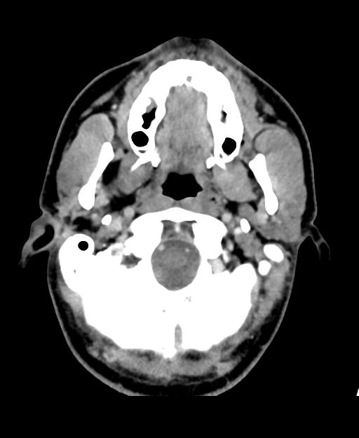 Branchial cleft cyst (Radiopaedia 31167-31875 Axial C+ delayed 9).jpg