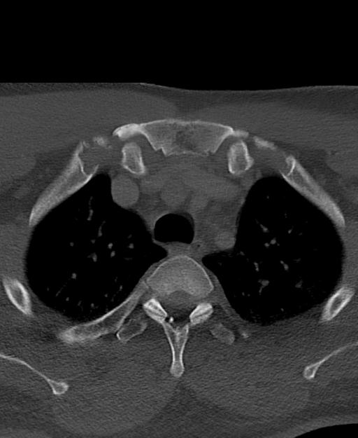 Branchial cleft cyst (Radiopaedia 31167-31875 Axial bone window 78).jpg