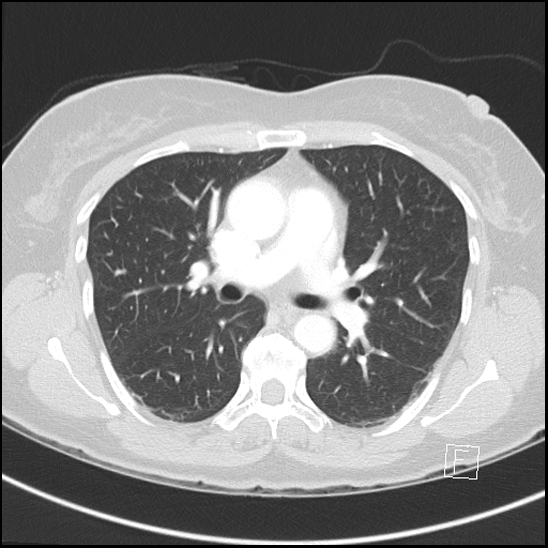 Breast metastases from renal cell cancer (Radiopaedia 79220-92225 Axial lung window 37).jpg