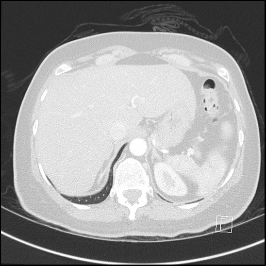 File:Breast metastases from renal cell cancer (Radiopaedia 79220-92225 Axial lung window 79).jpg