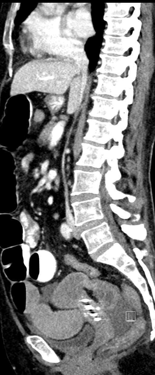 Broad ligament hernia (Radiopaedia 84802-100276 C 41).jpg