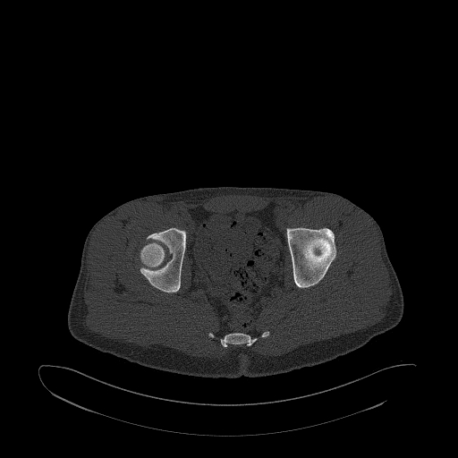 Brodie abscess- femoral neck (Radiopaedia 53862-59966 Axial bone window 124).jpg