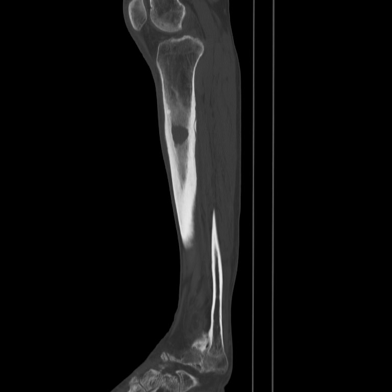 Brodie abscess - tibia (Radiopaedia 66028-75204 Sagittal bone window 43).jpg
