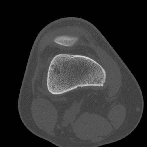 Brodie abscess of the tibia (Radiopaedia 58984-66250 Axial bone window 17).jpg
