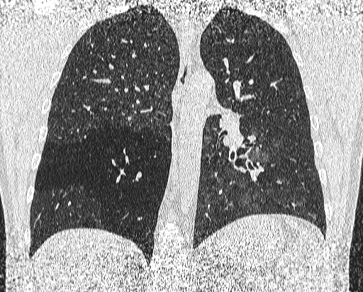 Bronchial atresia (Radiopaedia 58271-65417 Coronal lung window 37).jpg
