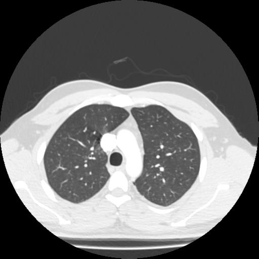 Bronchial carcinoid (Radiopaedia 80013-93291 Axial lung window 27).jpg