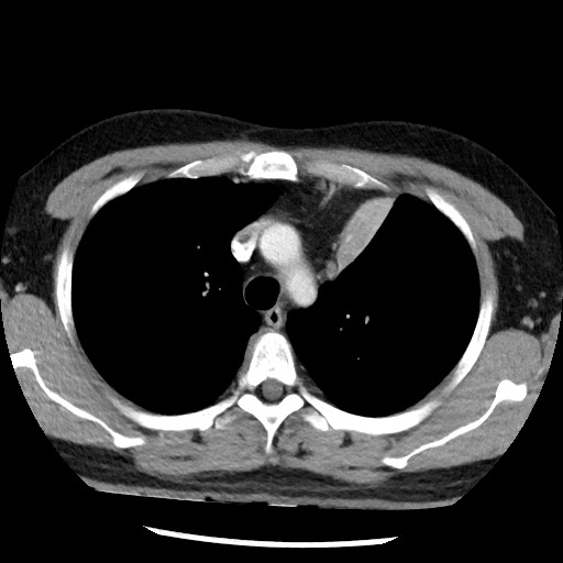 Bronchial carcinoid tumor (Radiopaedia 67377-76764 A 20).jpg