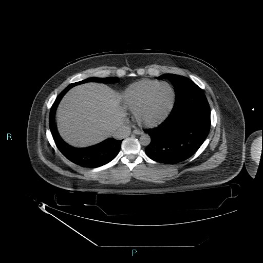Bronchial carcinoid tumor (Radiopaedia 78272-90870 Axial non-contrast 79).jpg