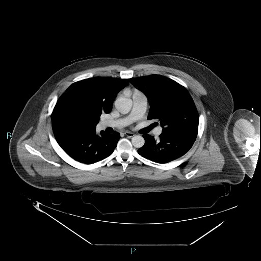 Bronchial carcinoid tumor (Radiopaedia 78272-90870 C 58).jpg