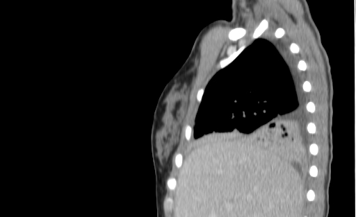 Bronchial mucoepidermoid carcinoma (Radiopaedia 57023-63895 Sagittal 37).jpg
