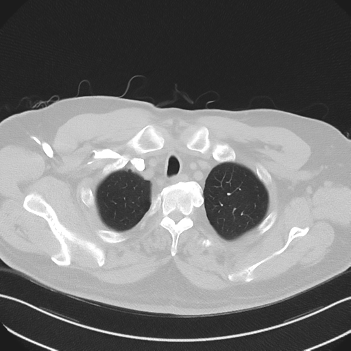 File:Bronchiectasis (Radiopaedia 39385-41666 Axial lung window 11).png