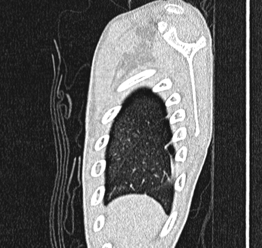 Bronchiolitis obliterans (Radiopaedia 71538-81897 Sagittal lung window 3).jpg