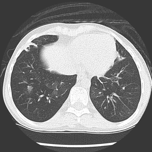 Bronchiolotis obliterans (Radiopaedia 73769-84575 Axial lung window 36).jpg
