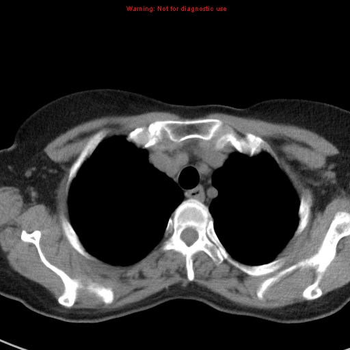File:Bronchoalveolar carcinoma (BAC) (Radiopaedia 13436-13392 Axial non-contrast 9).jpg