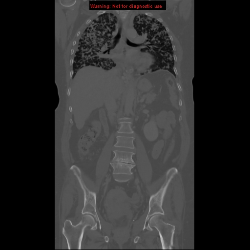 File:Bronchoalveolar carcinoma (Radiopaedia 13224-13233 Coronal non-contrast 12).jpg