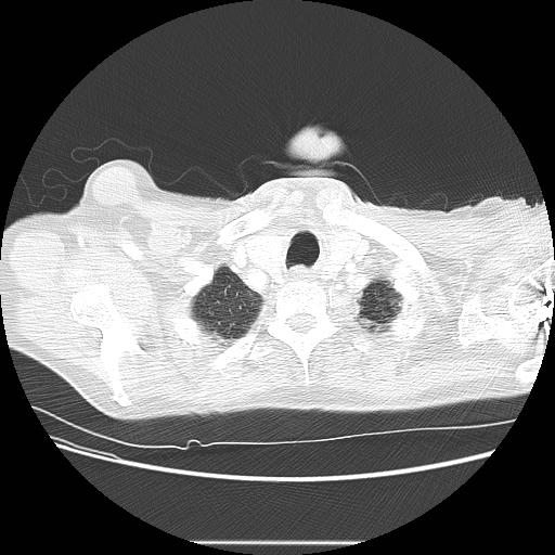 Bronchocele (Radiopaedia 17097-16795 Axial lung window 10).jpg