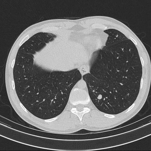 File:Bronchocele (Radiopaedia 60676-68429 Axial lung window 59).jpg