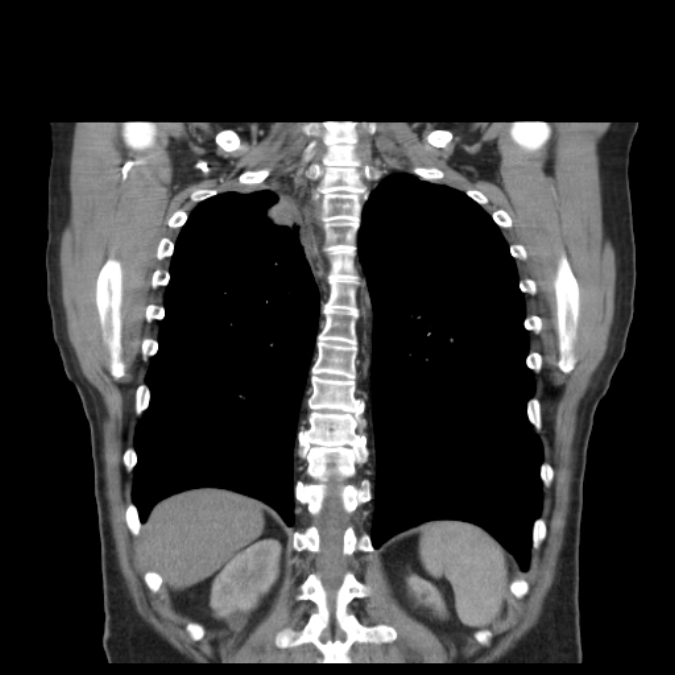 Bronchogenic carcinoma with upper lobe collapse (Radiopaedia 29297-29726 D 41).jpg