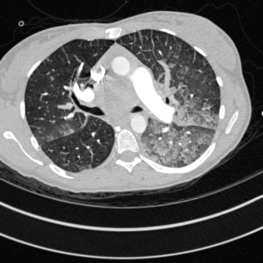Bronchogenic cyst (Radiopaedia 77801-90071 Axial lung window 24).jpg
