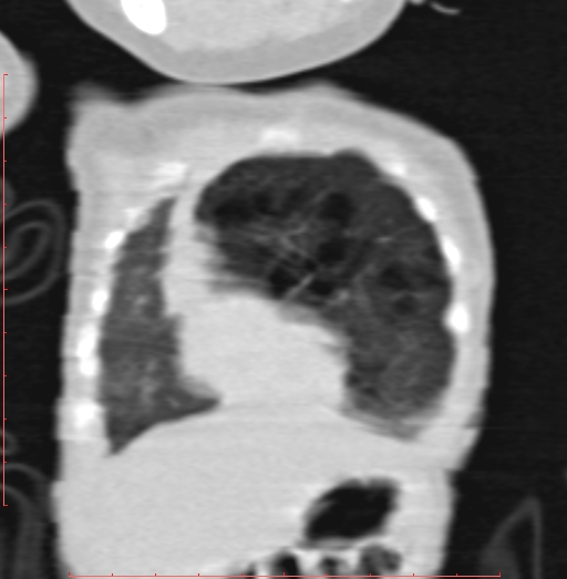 Bronchogenic cyst (Radiopaedia 78599-91409 Coronal lung window 44).jpg