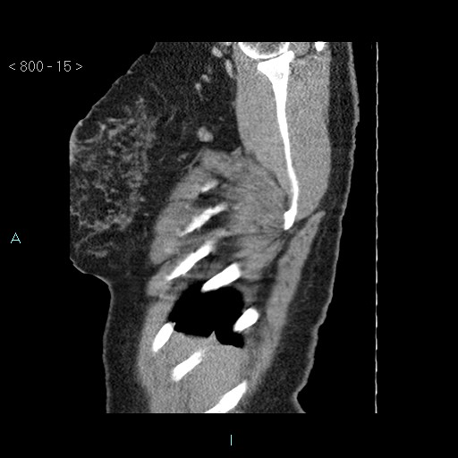 Bronchogenic cyst - posterior mediastinal (Radiopaedia 43885-47364 B 10).jpg