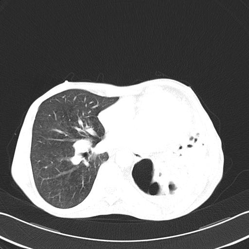 Bronchopleural fistula secondary to tuberculosis (Radiopaedia 20415-20322 Axial lung window 35).jpg