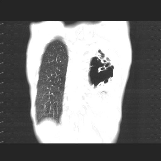 File:Bronchopleural fistula secondary to tuberculosis (Radiopaedia 20415-20322 Coronal lung window 20).jpg