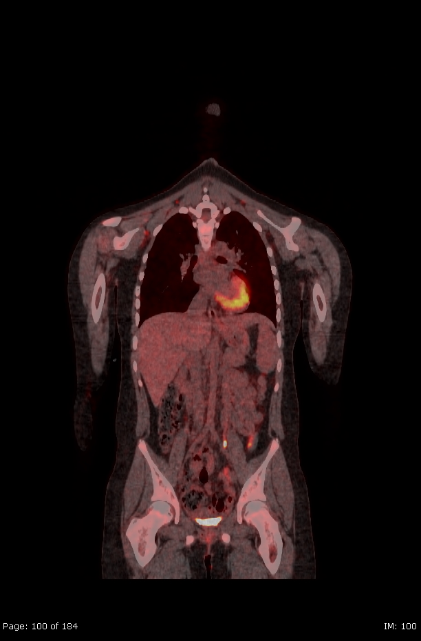 Brown fat uptake (FDG PET-CT) (Radiopaedia 77392-89513 Fused coronal 58).jpg