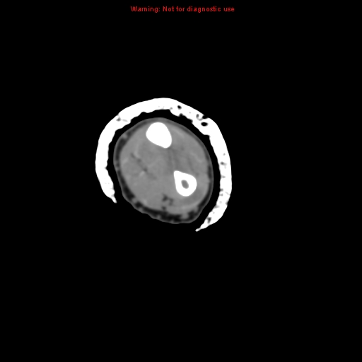 Brown tumor (Radiopaedia 12460-12694 Axial non-contrast 82).jpg