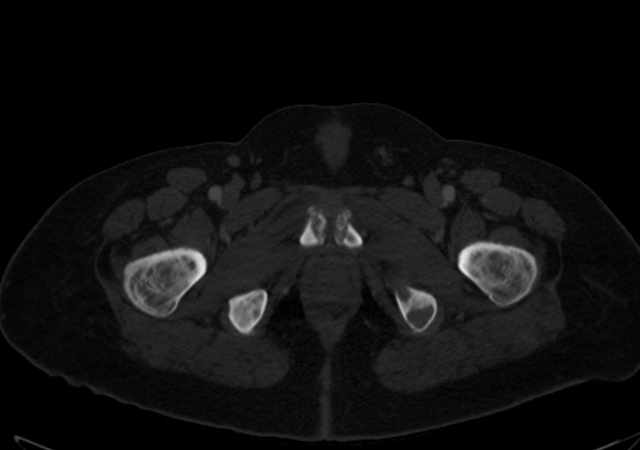 Brown tumors compressing the spinal cord (Radiopaedia 68442-77988 G 133).jpg