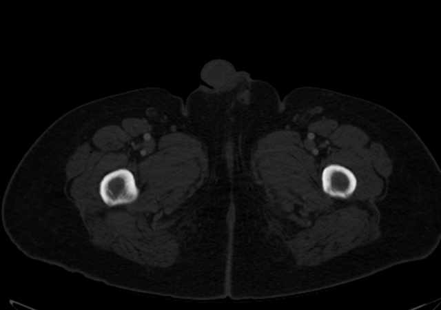 Brown tumors compressing the spinal cord (Radiopaedia 68442-77988 G 145).jpg