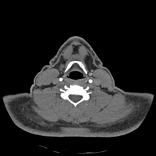Buccal fat pad arteriovenous malformation (Radiopaedia 70936-81144 D 121).jpg