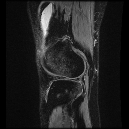 File:Bucket handle meniscus tear (Radiopaedia 56916-63751 H 14).jpg