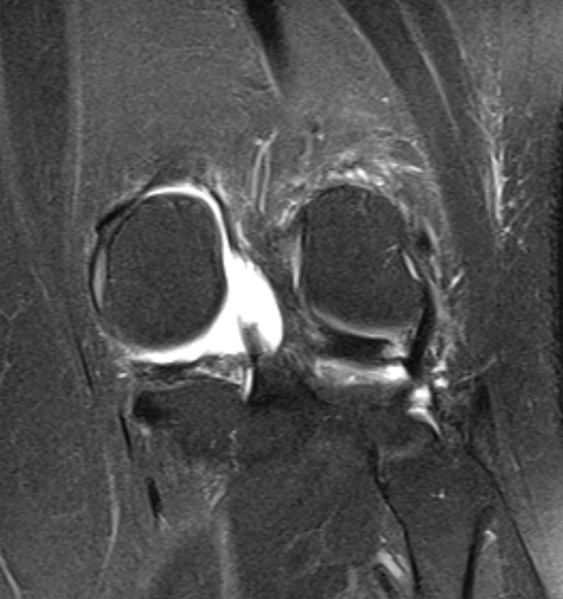 File:Bucket handle tear - medial meniscus (Radiopaedia 79028-91942 Coronal PD fat sat 4).jpg