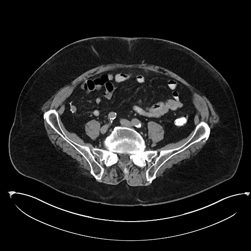 File:Buried bumper syndrome - gastrostomy tube (Radiopaedia 63843-72577 Axial Inject 85).jpg