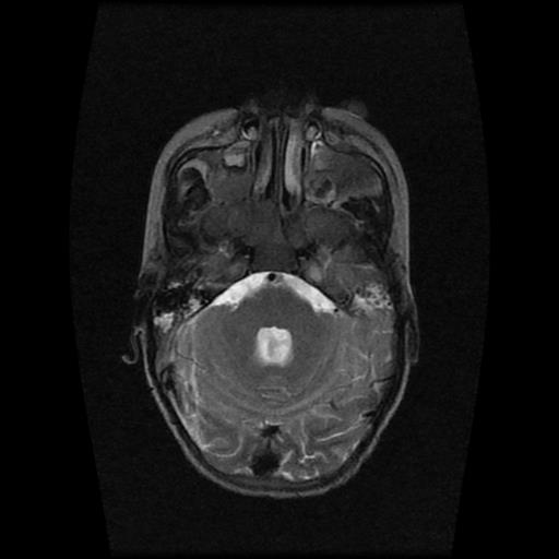 File:Burkitt lymphoma of the orbit- pre and post chemotherapy (Radiopaedia 31214-31929 Axial T2 4).jpg