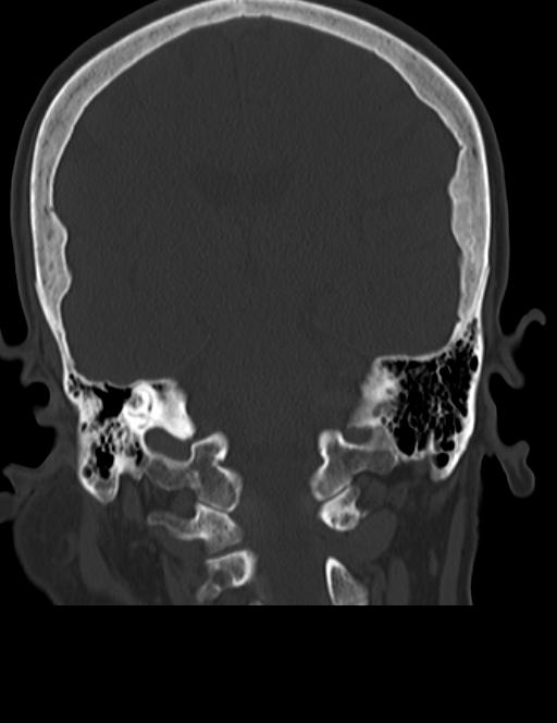 Burnt-out meningioma (Radiopaedia 51557-57337 Coronal bone window 32).jpg