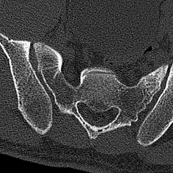 Burst fracture (Radiopaedia 53373-59357 Axial bone window 78).jpg