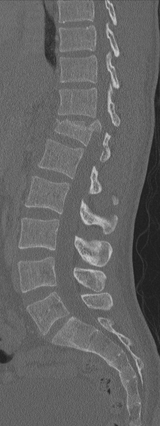 Burst fracture - T12 with conus compression (Radiopaedia 56825-63647 Sagittal bone window 45).png