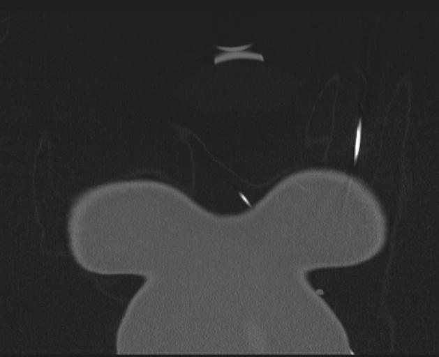 Burst fracture - thoracic spine (Radiopaedia 30238-30865 Coronal bone window 3).jpg