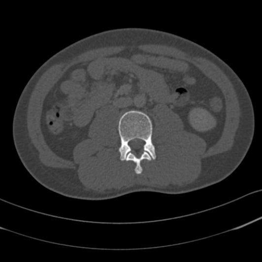 Burst fracture with cauda equina syndrome (Radiopaedia 25701-25867 Axial bone window 82).jpg