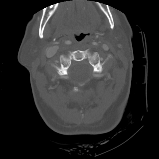 C1 anterior arch (plough) fracture - type 1 (Radiopaedia 76181-87720 Axial bone window 32).jpg