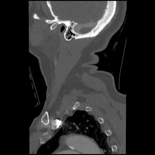 File:C1 anterior arch (plough) fracture - type 1 (Radiopaedia 76181-87720 Sagittal bone window 17).jpg